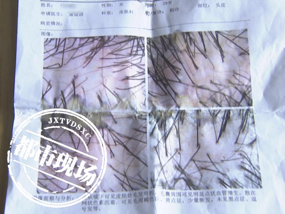 女子染发接发8小时后续,女生花1500染发结果秃了