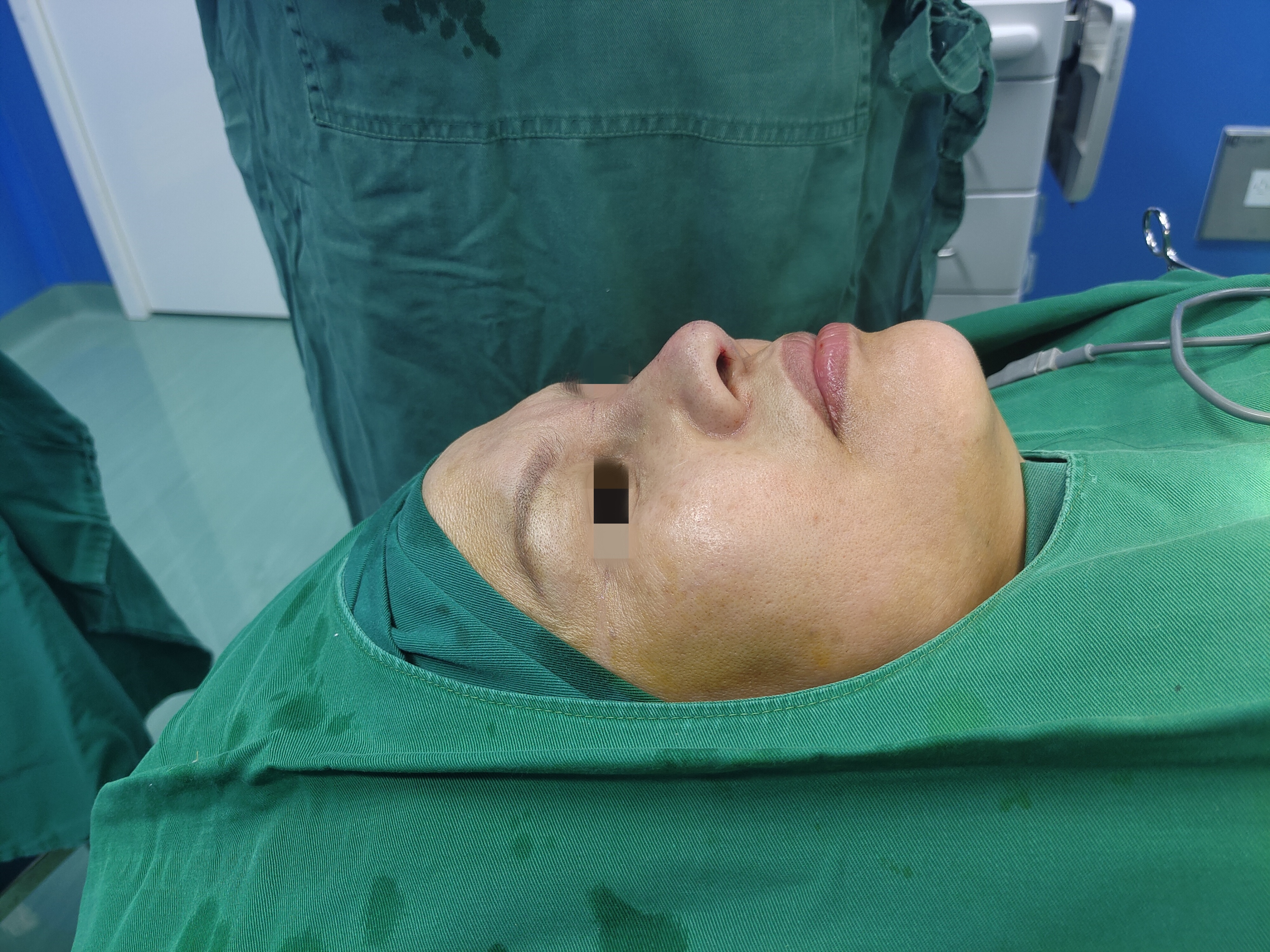 10年隆鼻假体取出后恢复图片,10年鼻假体取出会肿几天