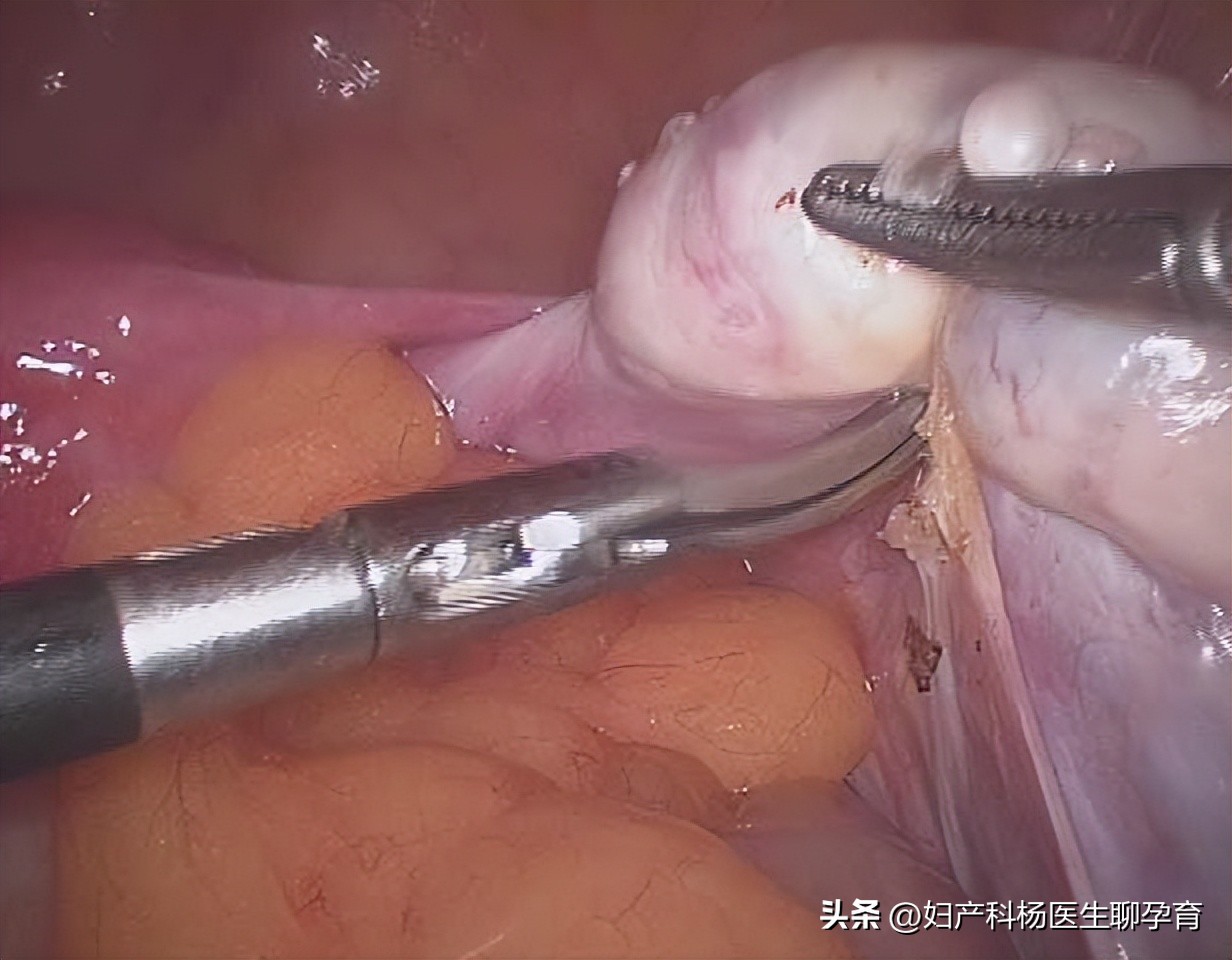 宫颈内口松弛导致孕早期流产,宫颈松弛导致流产症状是什么