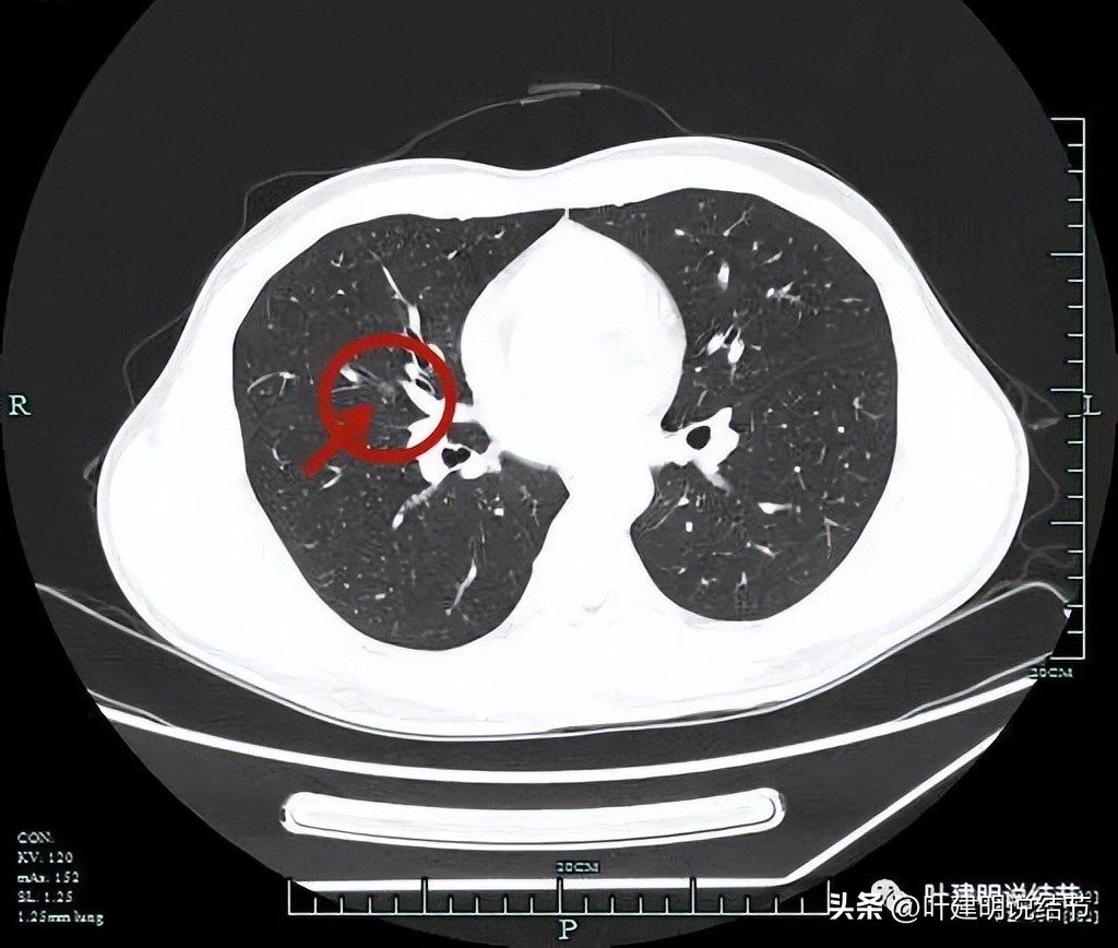 中叶多发微小结节,男性30岁右侧甲状腺单发结节