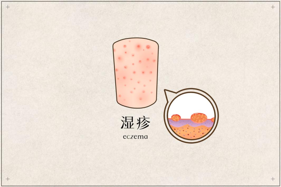 湿疹分为干性湿疹和湿性湿疹吗,湿疹反反复复到底是湿热还是湿寒