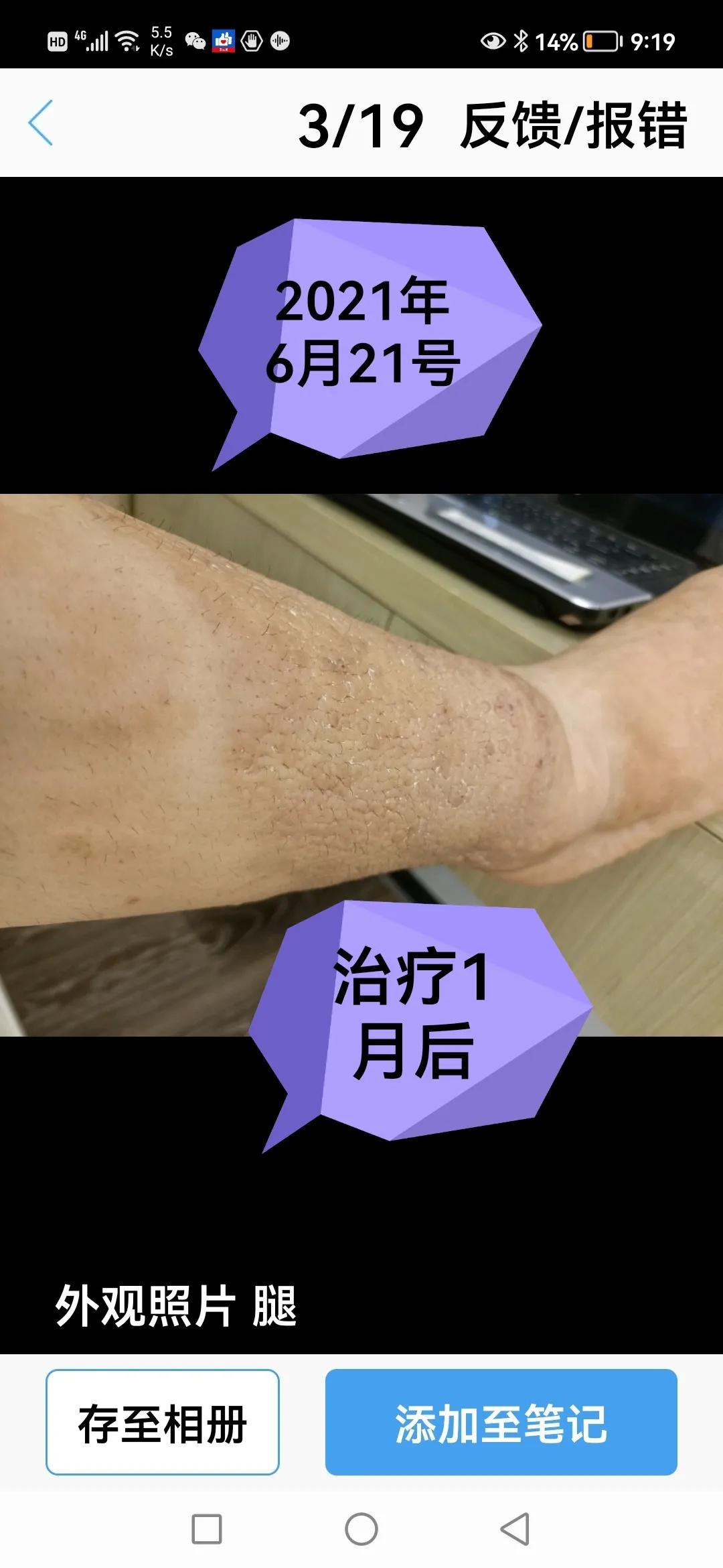 胫前骨粘液性水肿局部治疗,胫前粘液性水肿病例