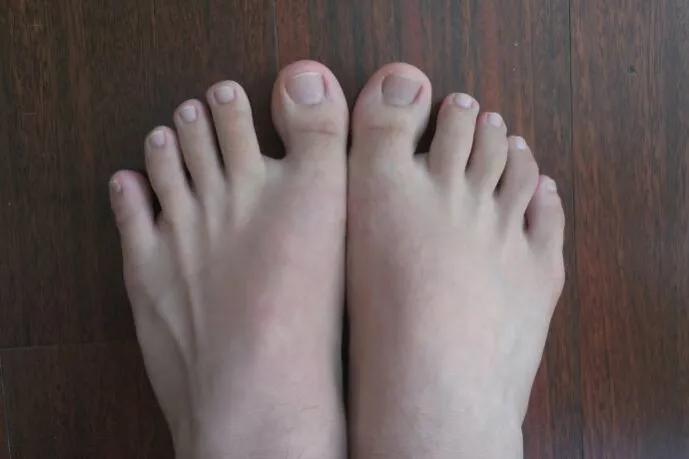 小脚趾被撞了骨头移位怎么办,小脚趾被磕到了一直疼怎么办