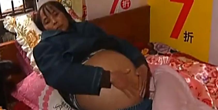 重庆一妇女肚子巨大,女子肚大如球竟是5颗肿瘤