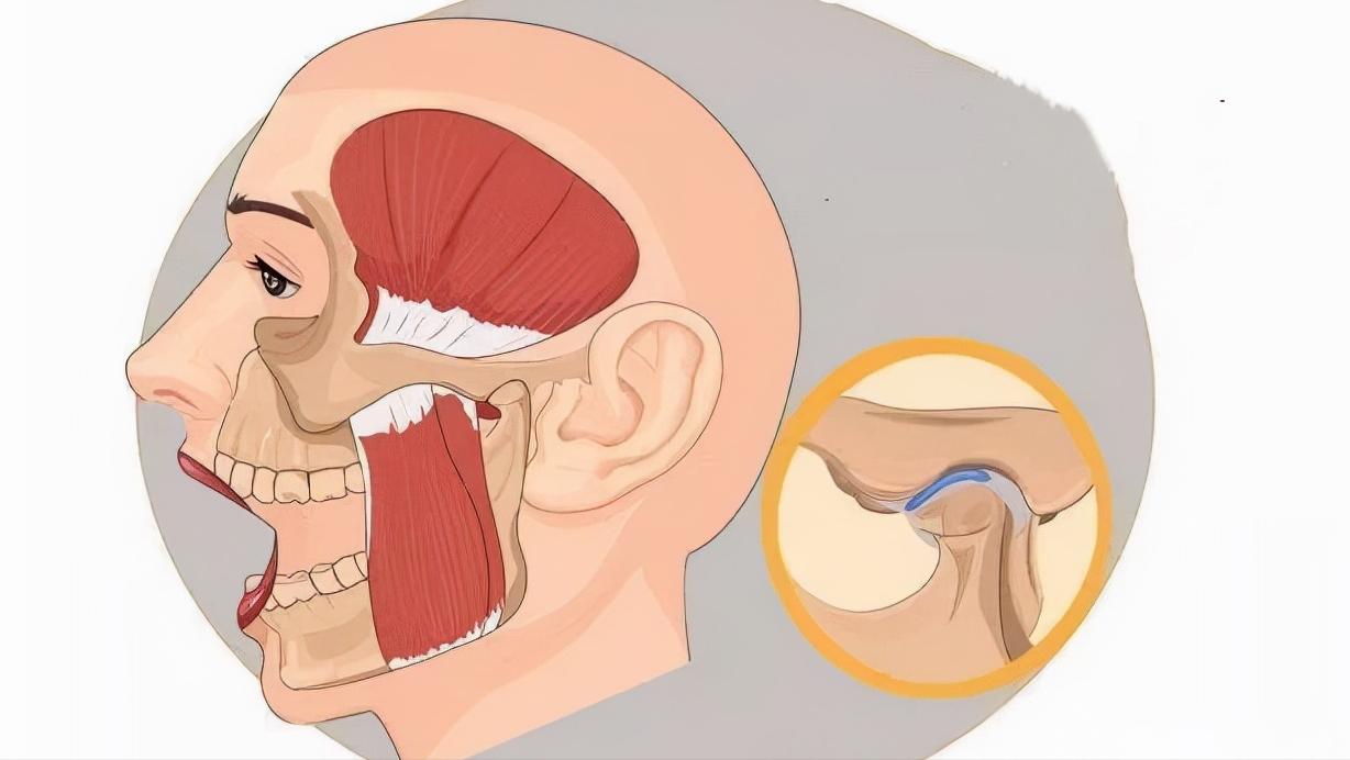张嘴发出咯噔的声音怎么治,张嘴腮帮子咔哒响还疼怎么治