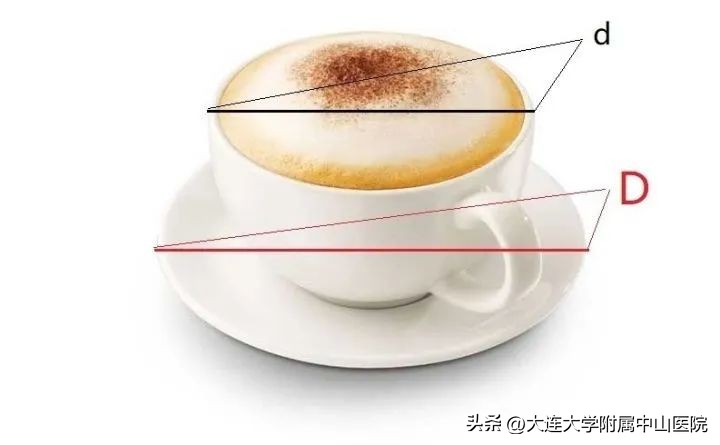 青光眼杯盘比用什么方法测量,世界青光眼日怎么防治