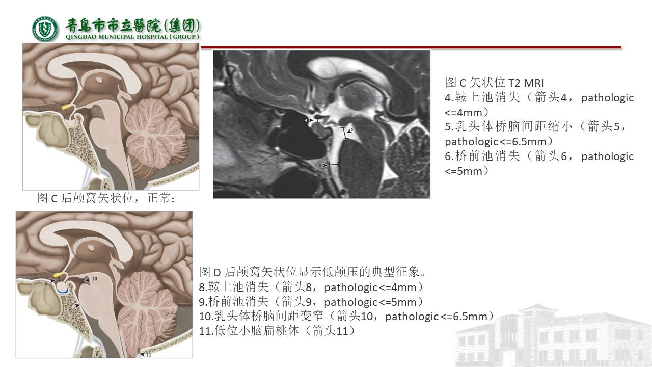 低颅压综合征耳闷,低颅压综合征吃什么药