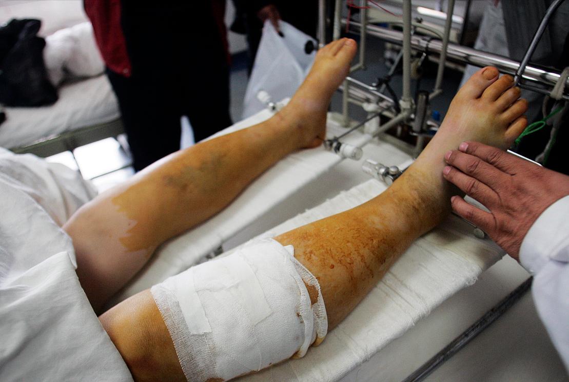 老年人怎么预防髋关节骨折,老年人易骨折怎么预防