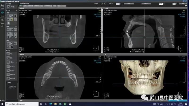 口腔科CBCT,口腔科cbct设备怎么选择