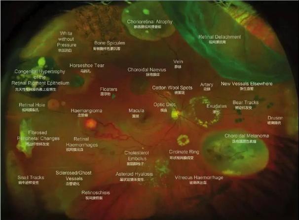 本想做近视手术，却发现眼底上破了个“洞”！需不需要治疗？