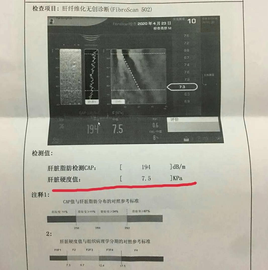 肝纤维化如何防止发展成肝硬化,肝纤维化和肝硬化一样吗