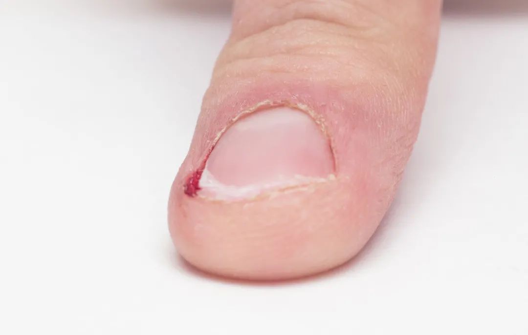 指甲上竖条纹白斑什么毛病,指甲盖上长出竖纹是什么病