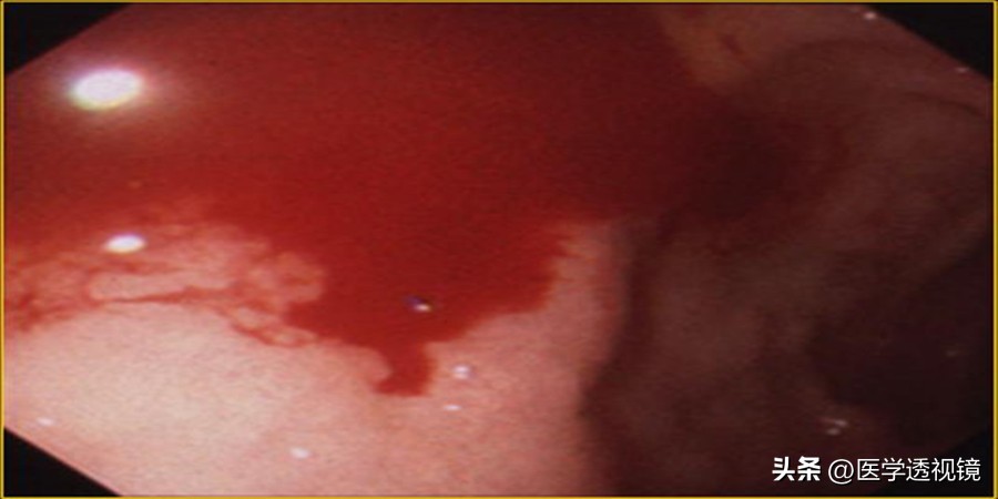 胃溃疡和十二指肠溃疡哪个更严重,胃溃疡和十二指肠溃疡区别是什么