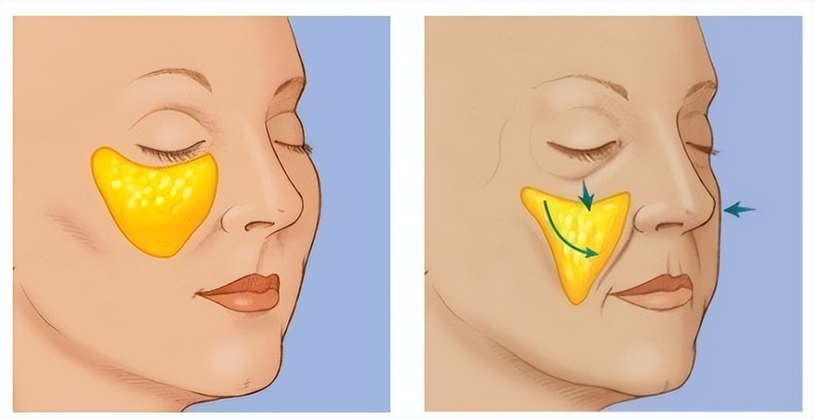 显老的罪魁祸首是什么,显老除了法令纹还有什么纹