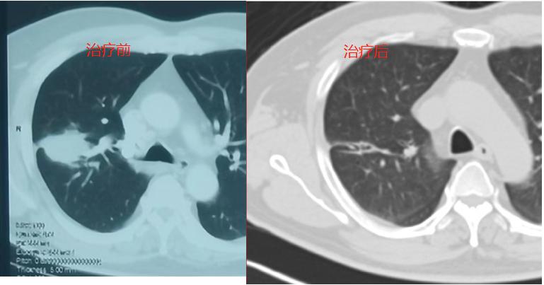 PET/CT病例（6）：4.0cm肺癌治疗后缩小到1cm，来看看治疗方案