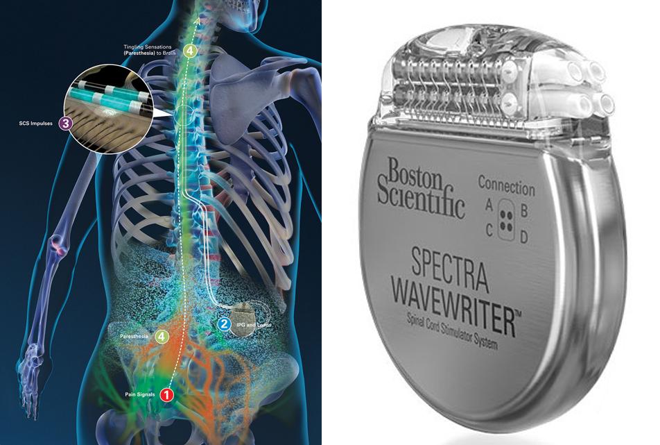 最好的脊髓电刺激器,脊髓刺激器治疗瘫痪