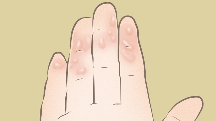 手上长水泡超痒和疱疹怎么办,手上水泡汗疱疹