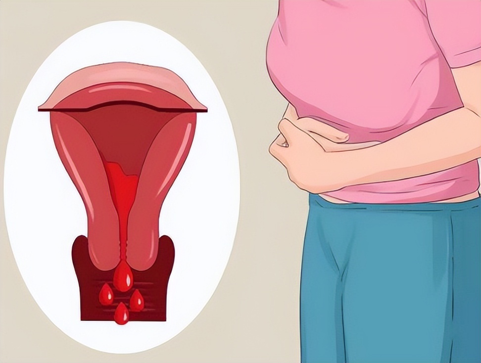 来例假时排出一团血块是怎么回事,来例假流出血块怎么回事