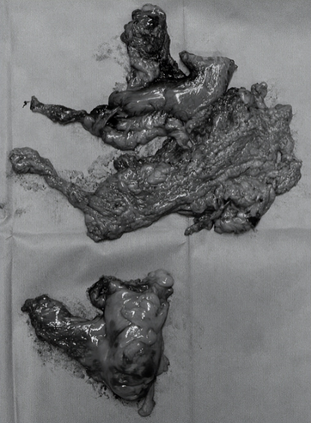 结直肠癌使用达芬奇手术机器人,哈医大二院达芬奇机器人手术