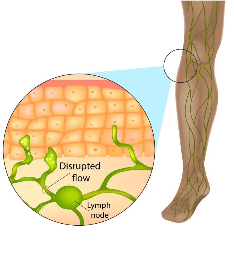 足部手术后肿胀如何处理,足部手术后肿胀发紫怎么消除