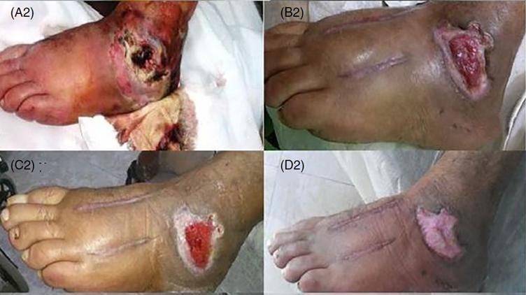 全球干细胞最新临床进展,干细胞治疗的发展历程知多少