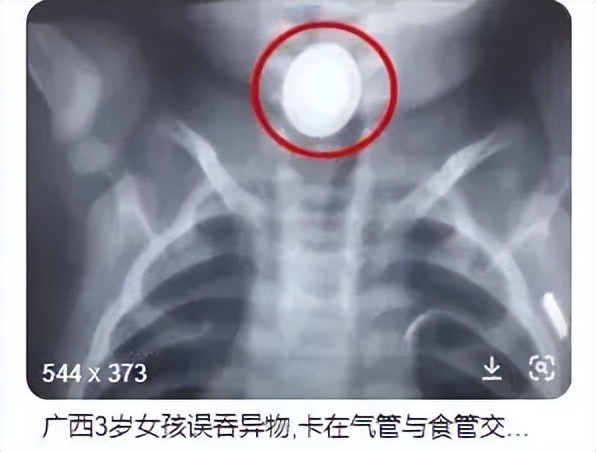 11个月大婴儿,吞下一枚3cm钉子!家长平时一定要收好家中小物品