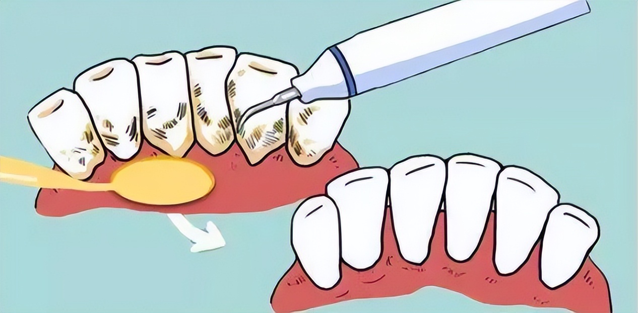 洗牙后出血严重多久能恢复正常啊,洗牙后几年牙齿容易出血怎么回事