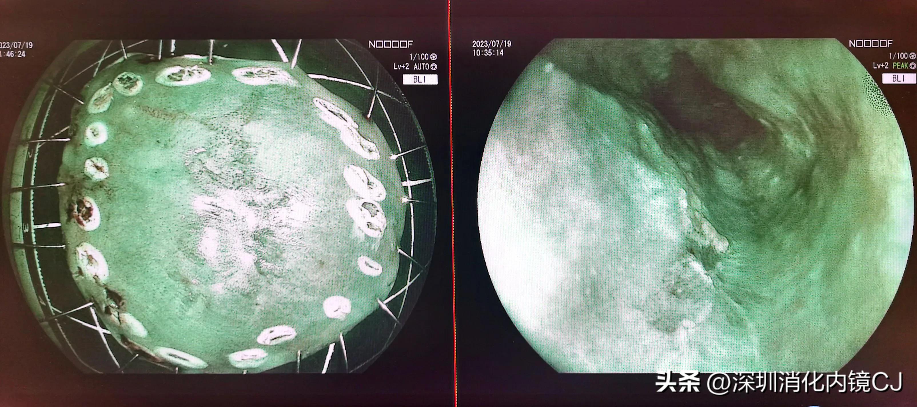 69岁及时发现食管癌，内镜下微创根治，避免了外科开胸手术