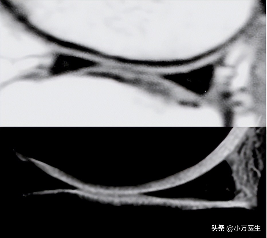 半月板后角撕裂微创手术,半月板撕裂分型