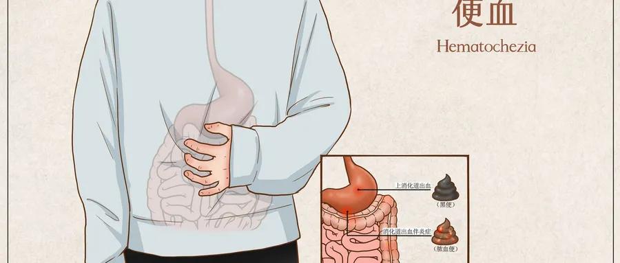 痔疮自测30秒,五个治痔疮的方法
