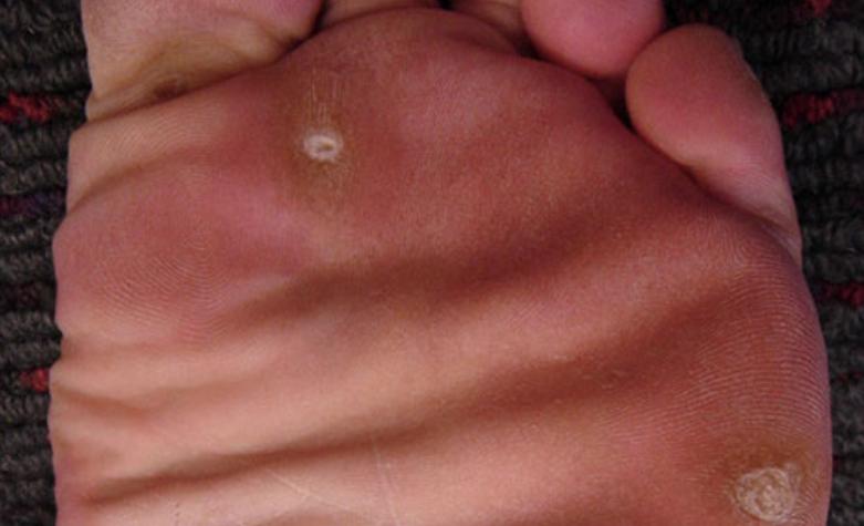 脚底板爱出汗怎么解决,脚底板爱出汗是什么原因造成的