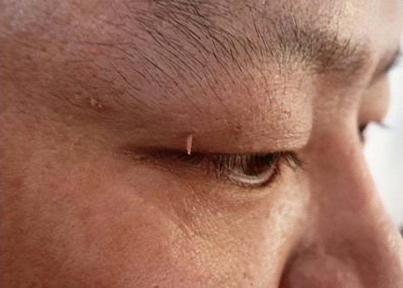 脖子和腋下的“小肉粒”是什么？能用手抠掉吗？看看医生如何说