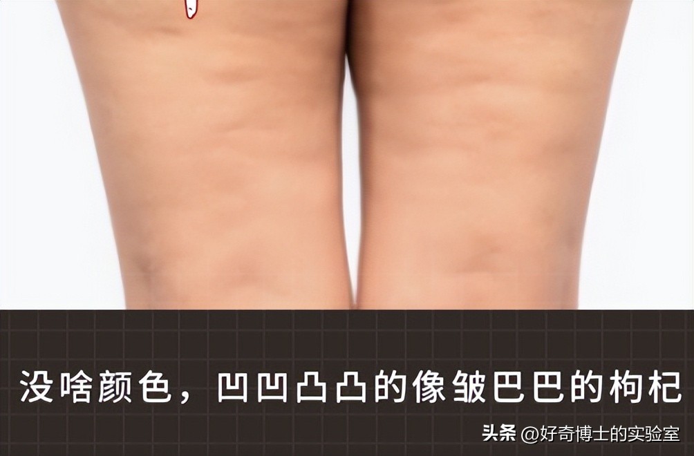 大腿上有白色条纹怎么回事,女生大腿外侧有红条纹是什么原因
