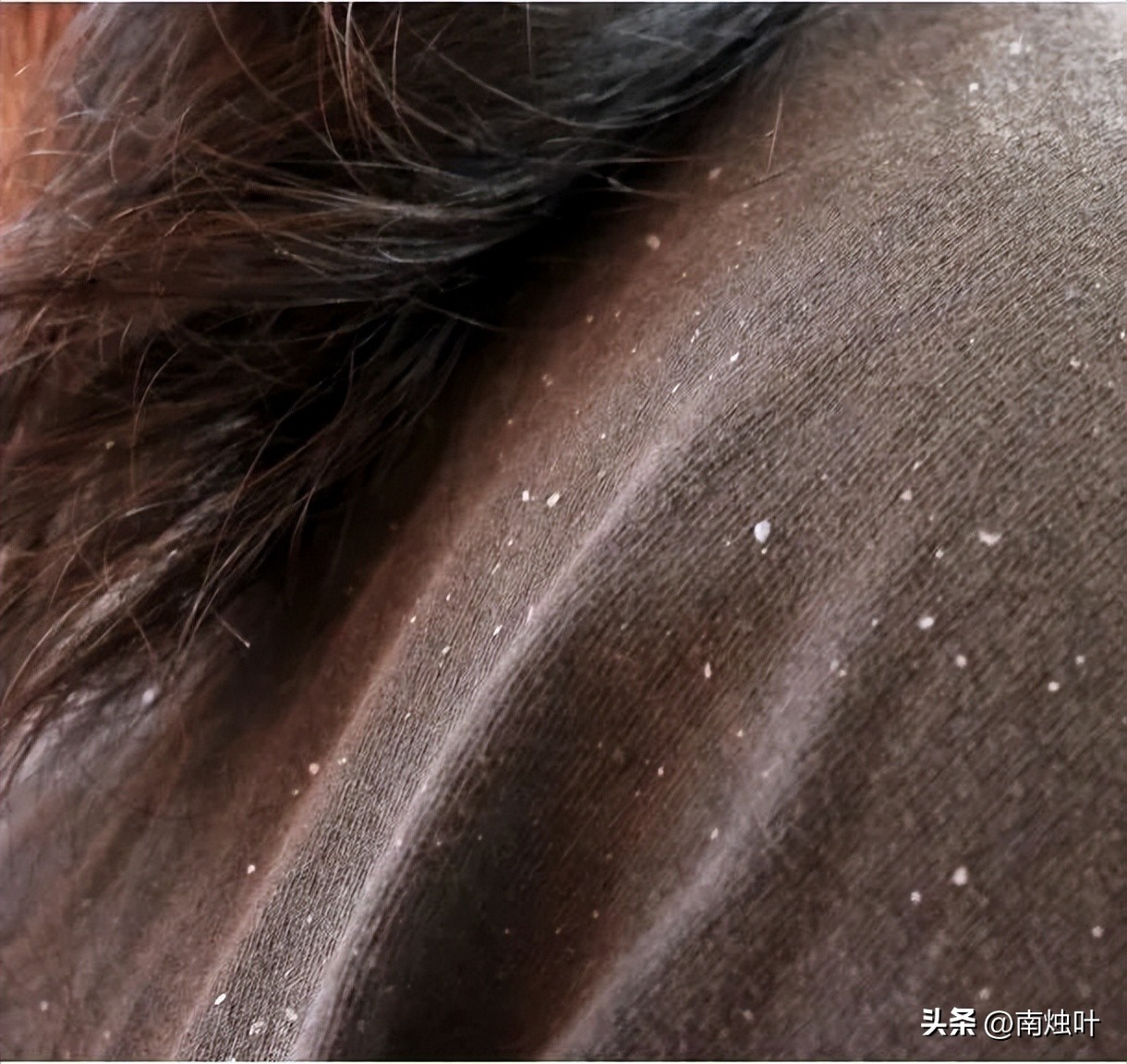 洗发水为什么越洗越多头屑,为什么用海飞丝洗头头屑越洗越多