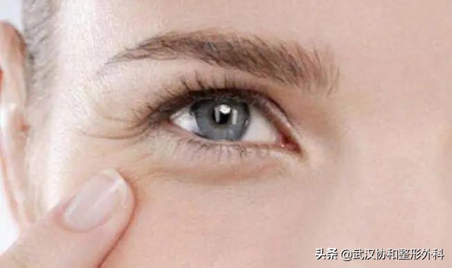 提眉术加开眼角,泡泡眼提眉术