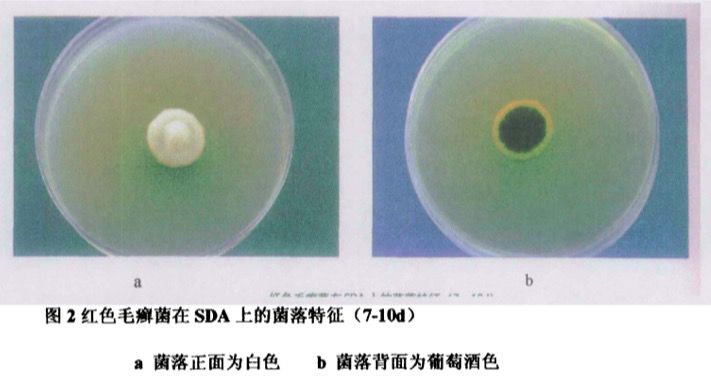 灰指甲反复处理不好根源在哪里,灰指甲治疗需要反复修理甲床吗