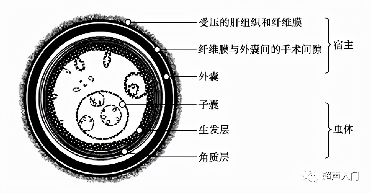 肝包虫病B超能检查出来吗?