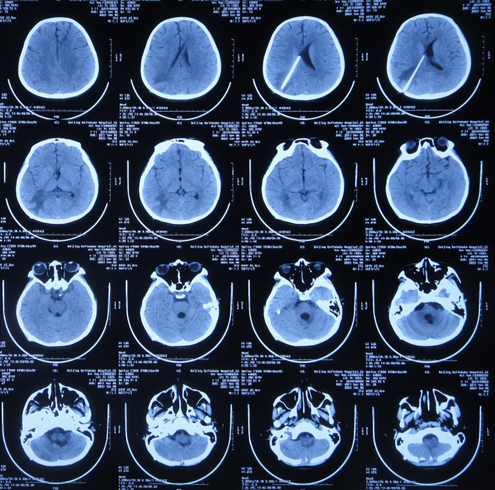 脑干出血儿童,儿童脑干胶质瘤呕吐