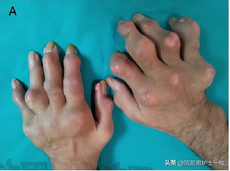 痛风诊治中需要注意哪些问题,痛风的治疗与饮食