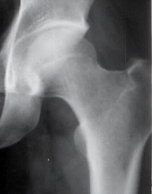 股骨头坏死保髋微创手术成功率,髋部骨头坏死微创手术康复训练