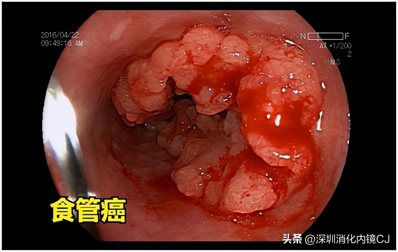 69岁及时发现食管癌，内镜下微创根治，避免了外科开胸手术
