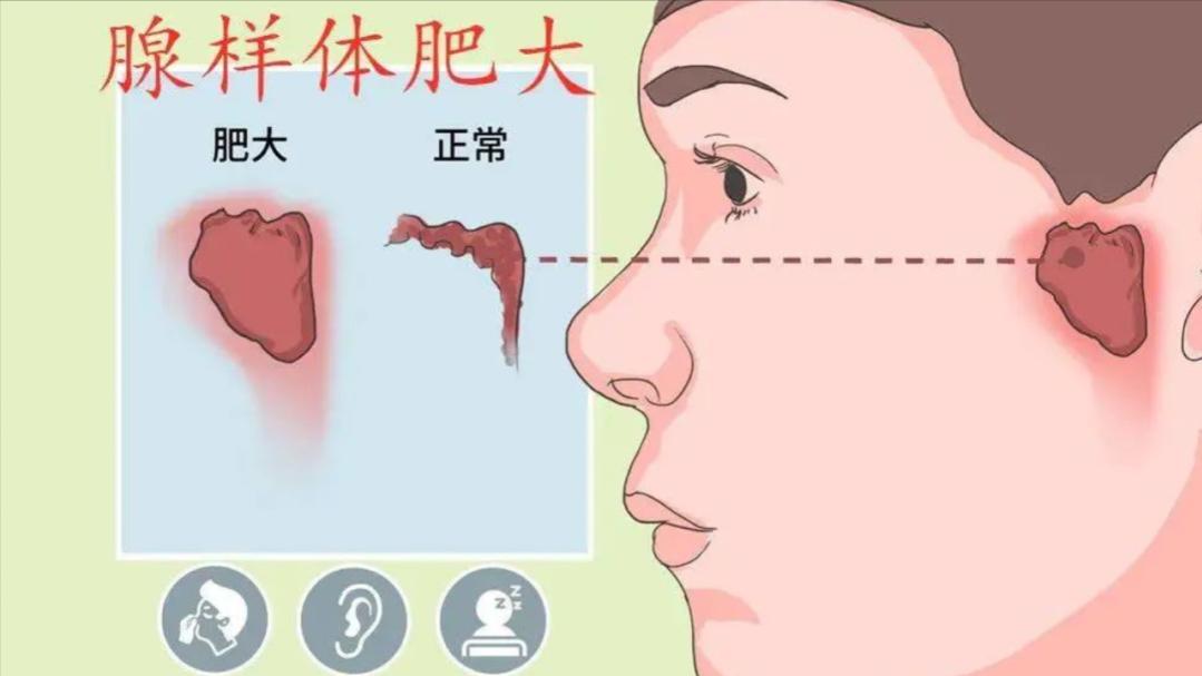 小孩腺样体肥大的危害和治疗,儿童腺样体肥大有哪些影响