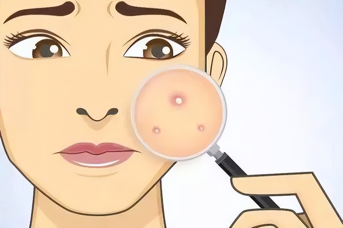 湿热型痤疮最有效的方子,中医治疗脸上痤疮痘痘的方剂