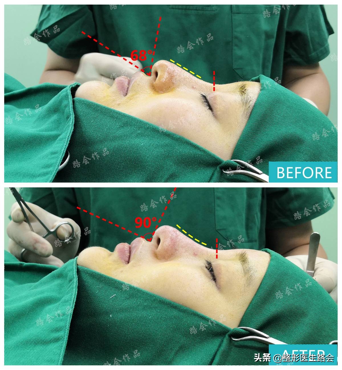 硅胶隆鼻和耳软骨隆鼻效果图,硅胶耳软骨隆鼻副作用