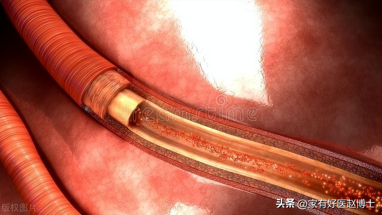 高血压脉压差大有什么危害,治疗老年脉压差大的中成药