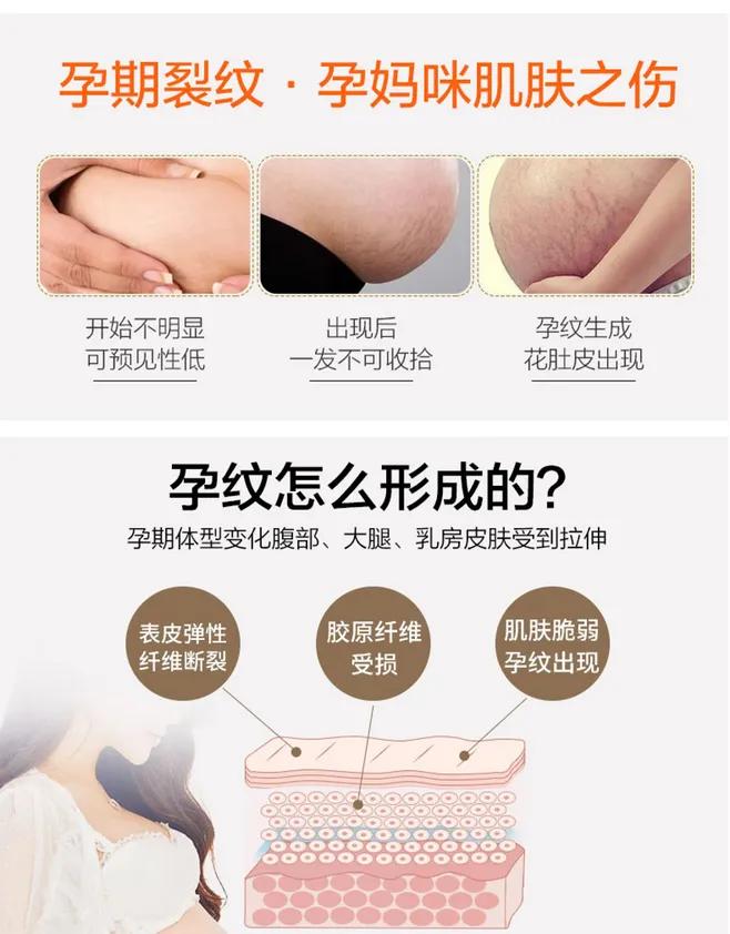 olioli修纹膏修复妊娠纹有用吗,5年祛妊娠纹最有效的方法