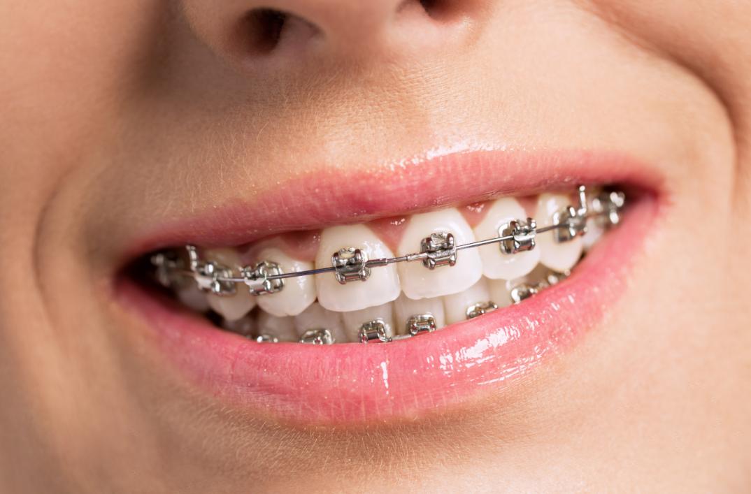 正畸治疗须知,正畸有哪些注意事项