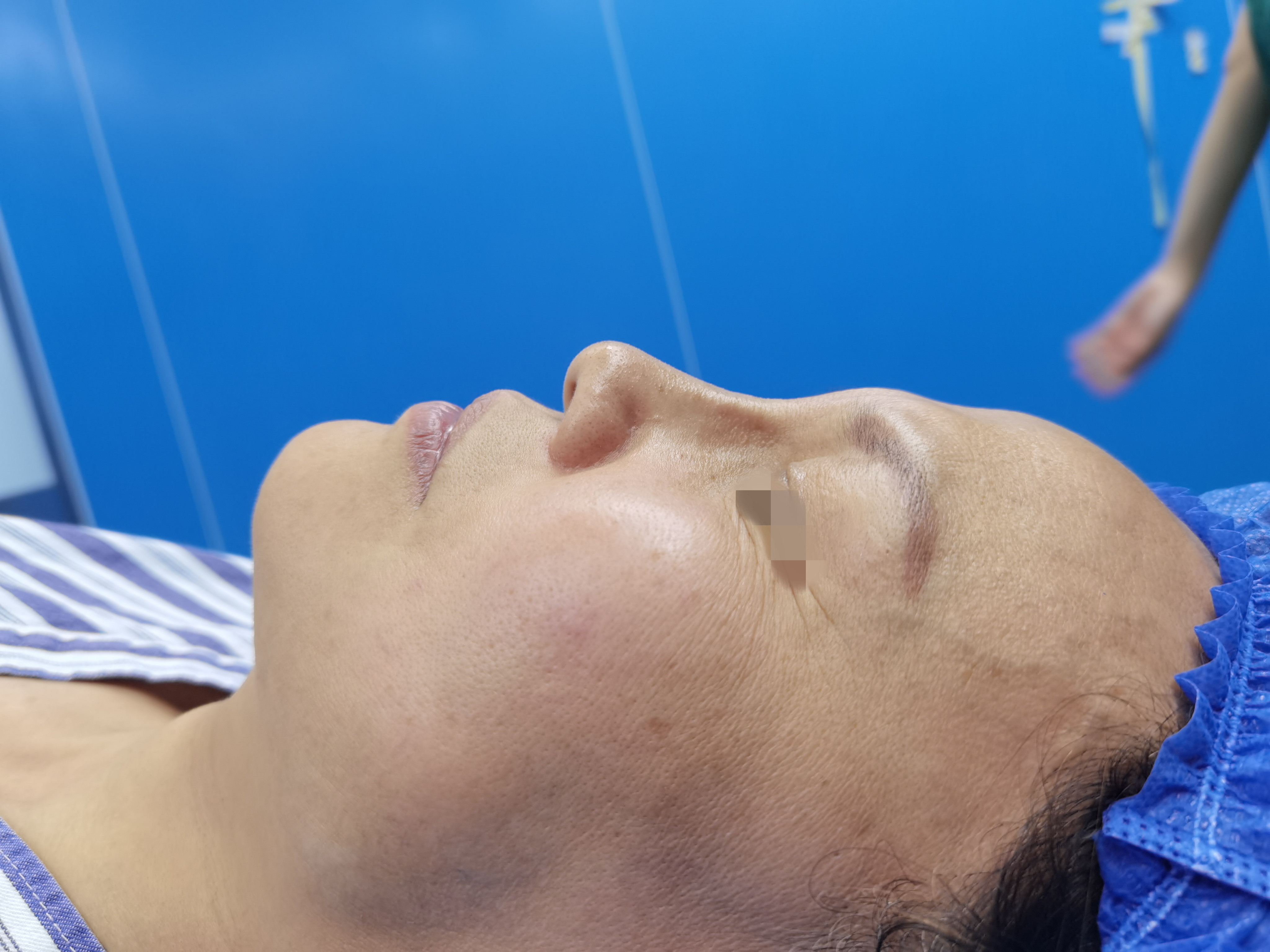 10年隆鼻假体取出后恢复图片,10年鼻假体取出会肿几天