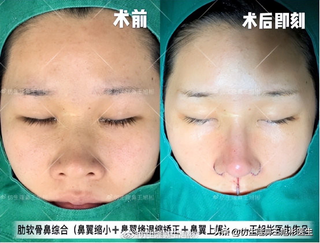 鼻翼缩小可以改善鼻翼缘后缩吗,鼻翼肥大如何正确改善