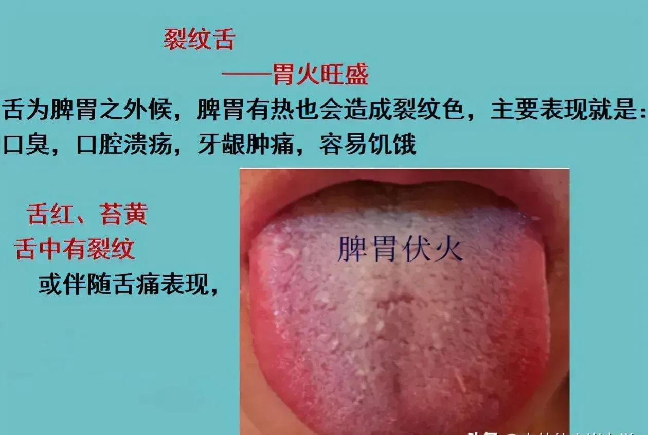 阴虚裂纹舌怎么调理,裂纹舌调理的经历